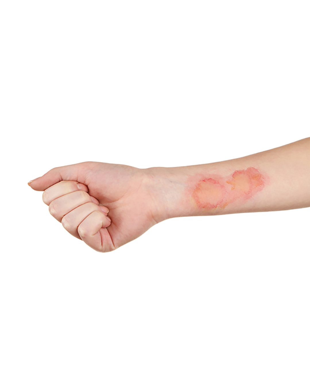 Step-by-step Treatment for a Minor Burn: