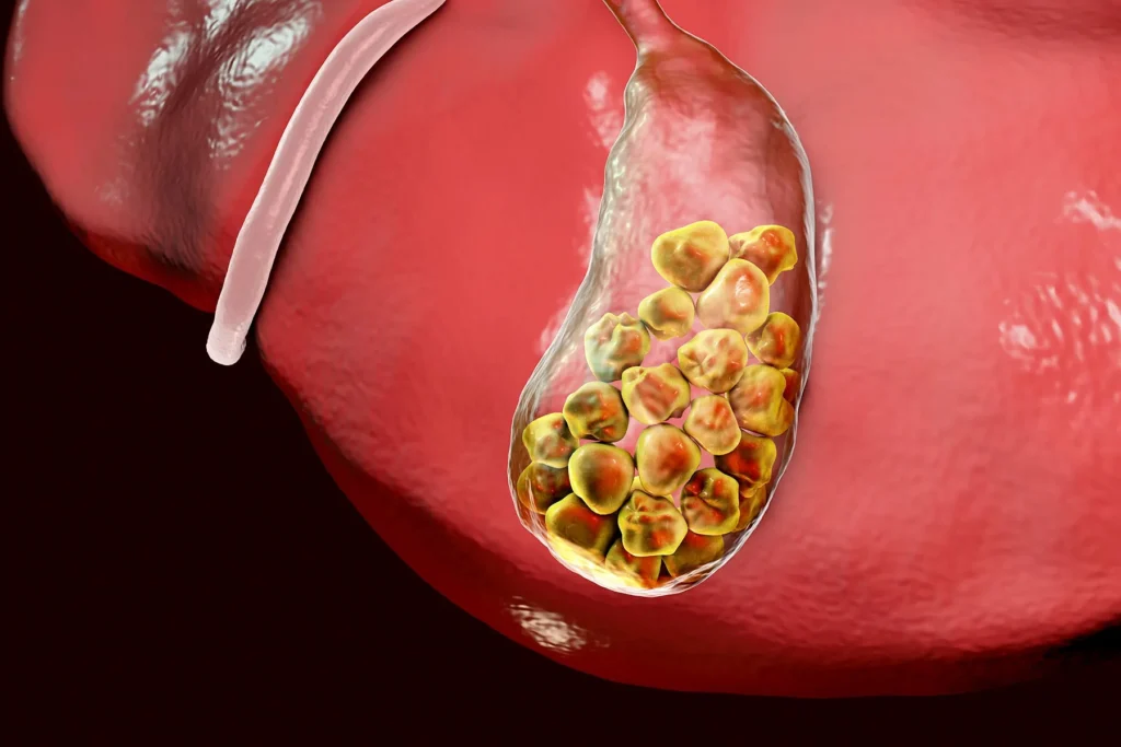 what are the symptoms of gallstone