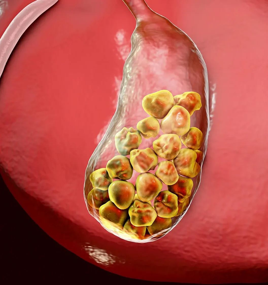 what is gallstone